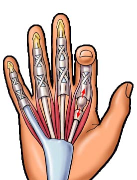 手指屈肌腱鞘炎 彈響指 彈撥指 板機狀指 扳機指