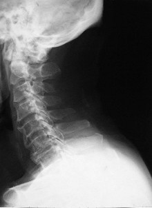頸椎後縱韌帶骨化癥 頸椎後縱韌帶骨化日本人病
