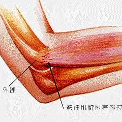 肱骨外上髁炎 網球肘