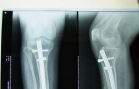 成骨不全 脆骨癥原發性骨脆癥骨膜發育不良