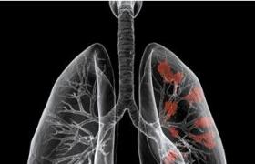 肺癌 支氣管癌 支氣管肺癌 肺部惡性腫瘤