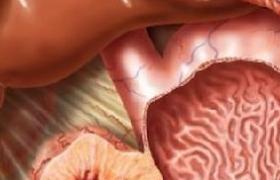 胃腸道間質瘤 GIST