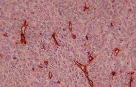 惡性血管內皮細胞瘤 M91300 3 血管肉瘤