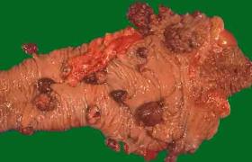 肝腺瘤 肝細胞腺瘤肝臟腺瘤