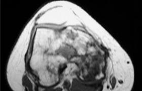 原發性骨淋巴瘤 原發性骨網狀細胞肉瘤