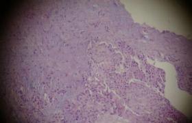 粘液表皮樣癌 M84300 3 粘液表皮樣腫瘤