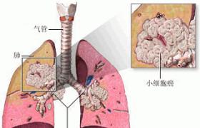 非小細胞肺癌