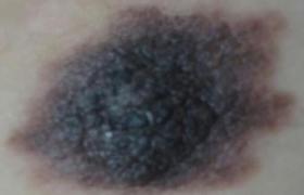 黑色素瘤 惡性黑色素瘤