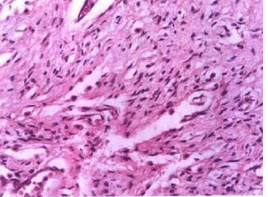 神經纖維瘤 神經膜瘤 神經瘤 神經周圍纖維瘤 雪旺細胞瘤 神經周圍纖維母細胞瘤
