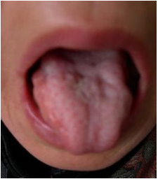 舌癌 舌巖 舌疳