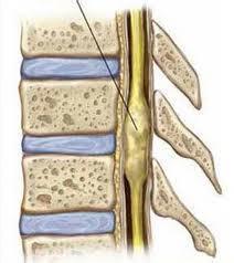 脊髓腫瘤 Spinal cord tumor