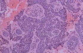 基底細胞腺瘤 涎腺上皮性良性腫瘤