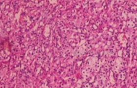 毛胚細胞瘤