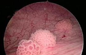 膀胱葡萄狀肉瘤 膀眈胱葡萄狀肉瘤膀胱橫紋肌肉瘤