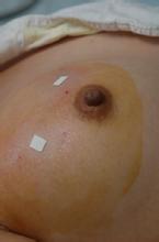 乳腺脂肪肉瘤 乳腺脂肉瘤乳房成脂細胞瘤乳房脂母細胞瘤