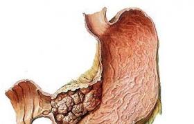食管肉瘤