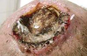 頭部鱗狀細胞癌 頭部扁平細胞癌頭部表皮樣癌頭部棘細胞癌頭部鱗癌頭部鱗狀上皮細胞癌