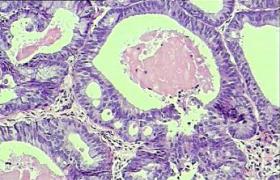 透明細胞棘皮瘤 蒼白細胞棘皮瘤明細胞棘皮瘤