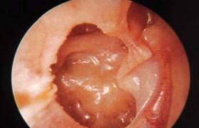 外耳道乳頭狀瘤 D23.251