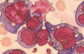 網狀細胞肉瘤
