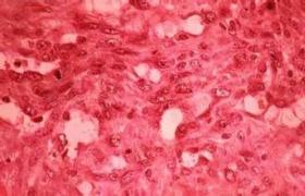 血管周細胞瘤