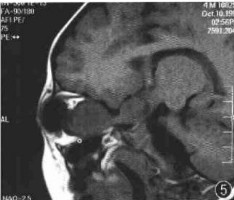 小兒視神經膠質瘤