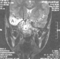 血管纖維瘤 Telangiectatic fibroma