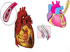 冠心病 I25.101 冠狀動脈性心臟病 冠狀動脈粥樣硬化性心臟病