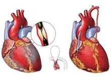 心臟瓣膜病 I38.X01 Valvular heart disease