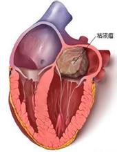 心臟黏液瘤 心臟粘液瘤