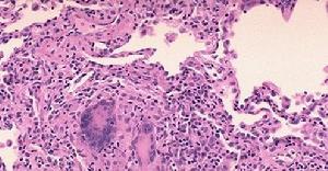 韋格納肉芽腫 M31.301 韋格內肉芽腫 韋格納肉芽腫病 壞死性肉芽腫