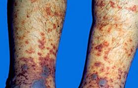 過敏性紫癜 亨諾-許蘭綜合征 葡萄疫 血風瘡