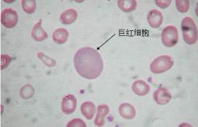 巨幼細胞性貧血 惡性貧血 巨幼紅細胞性貧血 巨幼貧 巨幼