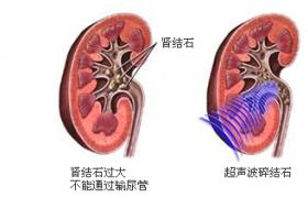 腎結石 N20.051 腎石病腎石 腎石癥
