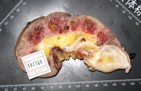 腎囊腫 單純性腎囊腫 孤立性腎囊腫 renal cyst cyst of kidney