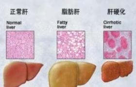 脂肪肝 K76.001 肝痞 肝癖 脂肝 fatty liver
