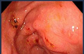 淺表性胃炎 淺表性胃粘膜炎癥 慢性淺表性胃炎