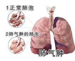 肺氣腫 阻塞性肺氣腫 終末細支氣管遠端部分慢性支