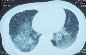 間質性肺炎 J84.901 間質性肺病 彌漫性實質性肺疾病