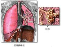 小細胞肺癌