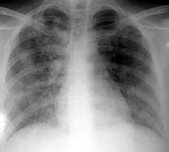 肺水腫 J81.X03