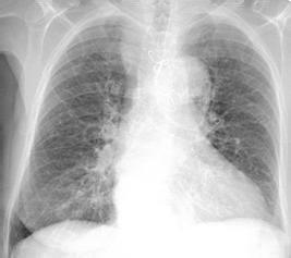 阻塞性肺氣腫 J43.905 慢阻肺 慢性阻塞性肺氣腫 COPD 肺脹