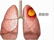 急性肺膿腫