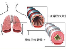 急性氣管支氣管炎 小兒急性氣管