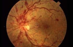 視網膜動脈栓塞 中央視網膜動脈阻塞 眼中風 視網膜動脈阻斷