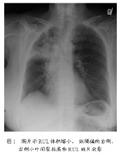 喘息性支氣管炎 asthmatoid bronchitis 哮喘性支氣管炎