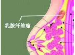 乳房纖維瘤 乳房瘤 纖維瘤