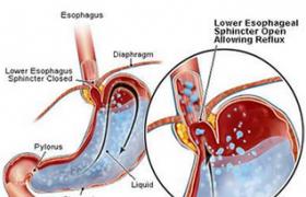 胃食管反流病 GERD 胃食管返流疾病 胃食管返流病