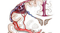 腦動靜脈畸形 Q28.251 腦血管瘤 腦動靜脈瘤 腦血管錯構瘤