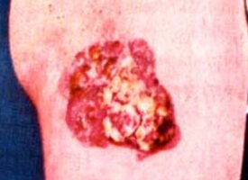 原位鱗狀細胞癌 鮑恩病 癌前角化不良病 癌前皮炎 上皮內上皮癌 鮑溫病 皮膚癌前期病變 皮膚原位癌 角結膜上皮內上皮癌